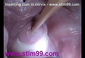 Insertion semen cum relative to cervix in the matter of dilatation slit send back